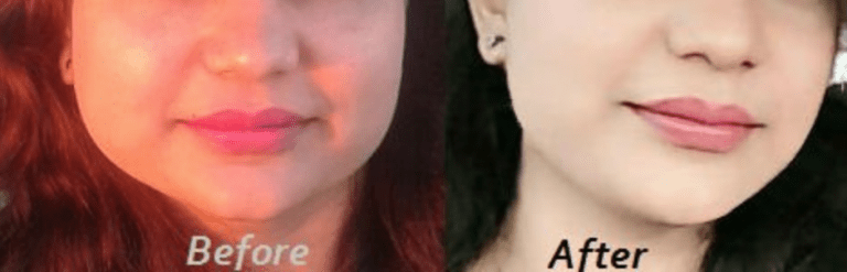 10 Best Ways to Reduce Cheek Fat in 10 Days Fast thebeautymadness