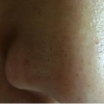blackheads from nose