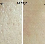 big pores