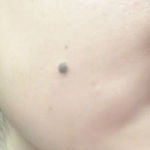 black spots