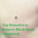 black spots