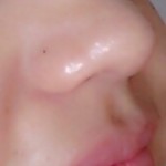 blackheads_removed