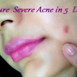 remedies to cure severe acne