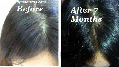 How to Regrow Hair on Bald Head - Powerful Natural Solutions -  thebeautymadness