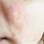 skin rashes