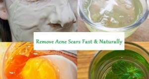 Top Ways to Remove Acne Scars Fast in 7 Days