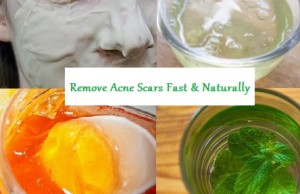 Top Ways to Remove Acne Scars Fast in 7 Days