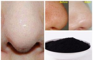 5 Super-Easy Remedies to Get Rid of Blackheads Instantly