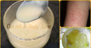 7 Best Ways to Get Rid of Body Acne