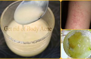 7 Best Ways to Get Rid of Body Acne