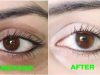 How to Remove Dark Circles Naturally in 3 Days (100% Results)