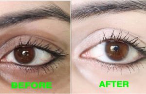 How to Remove Dark Circles Naturally in 3 Days (100% Results)