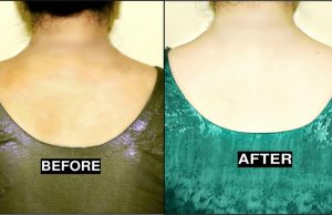Back Scrub – For Fair, Smooth, Clear, Pigmented & Tan Free Back