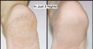 How to Get Rid of Cracked Heels in Just 3 Nights!
