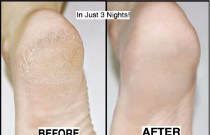 How to Get Rid of Cracked Heels in Just 3 Nights!
