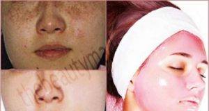 Vegetable Facial For Pigmented-free & Clear Glowing Complexion!