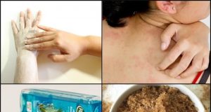 7 Instant Ways to Get Rid of Body Acne in Summer