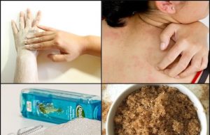 7 Instant Ways to Get Rid of Body Acne in Summer