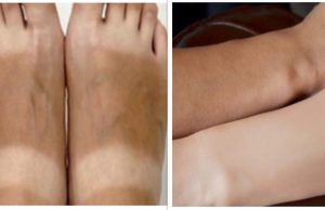 How to Remove Sun Tan from Face, Neck, Arms & Legs Instantly | thebeautymadness