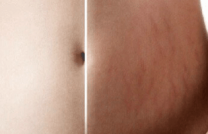 Banish stretch marks with this miracle pumpkin lotion!