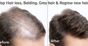 Regrow new hair | Stop hair loss | thebeautymadness