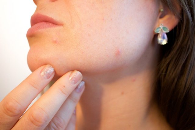 how-to-remove-dark-spots-thebeautymadness
