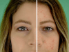 PIMPLE VANISHING POWDER