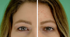 PIMPLE VANISHING POWDER