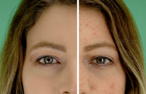 PIMPLE VANISHING POWDER