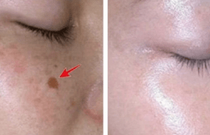 Lighten Up Your Skin: 6 Genius Hacks to Clear Dark Spots