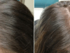 Hair fall will stop completely, if you use this before Bed