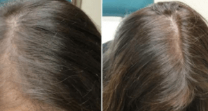 Hair fall will stop completely, if you use this before Bed