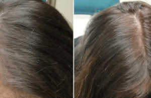 Hair fall will stop completely, if you use this before Bed
