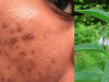 Pigmentation patches can be removed with this miracle formula! “I recommend that you try it, you may thank me later.”
