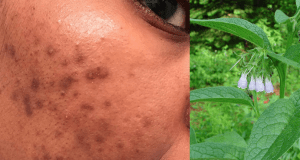 Pigmentation patches can be removed with this miracle formula! “I recommend that you try it, you may thank me later.”