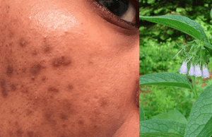 Pigmentation patches can be removed with this miracle formula! “I recommend that you try it, you may thank me later.”