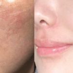 skin15