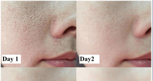 Transform Your Skin in Just 7 Days with These Two Unique Beauty Hacks – “smooth, poreless texture and glowing skin”