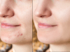 scrubs for “instant” clean clear skin, pimple-free skin