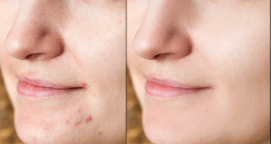 scrubs for “instant” clean clear skin, pimple-free skin