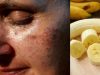 Remove Pigmentation patches easily At Home