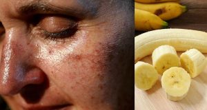 Remove Pigmentation patches easily At Home