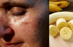 Remove Pigmentation patches easily At Home